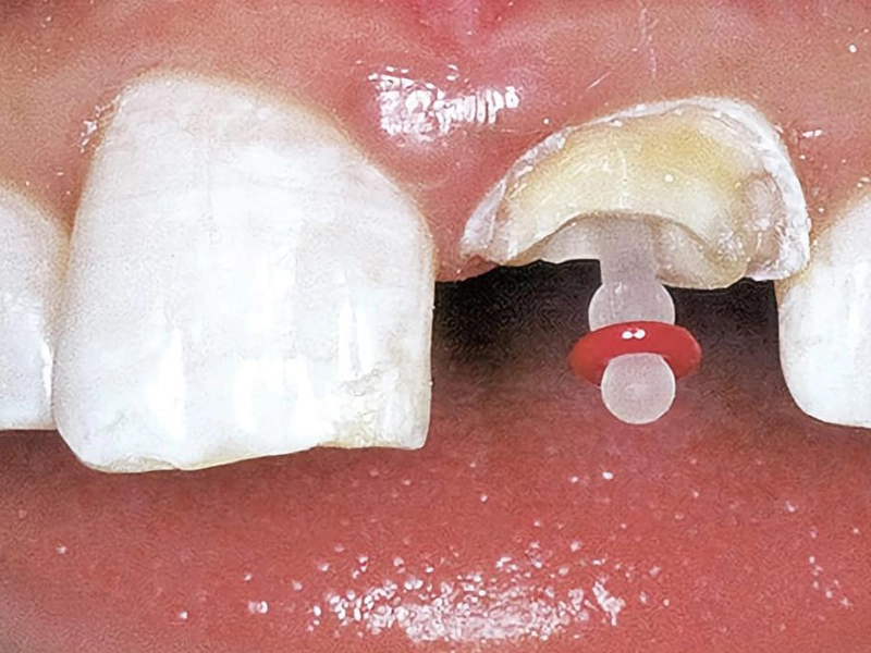 2.ルートポストのcementation